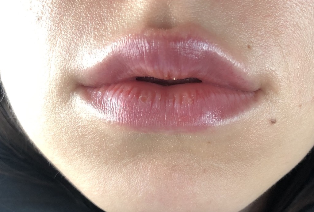 Опухшие губы после поцелуя