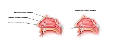 Двусторонняя вазотомия с латеропозицией нижних носовых раковин
