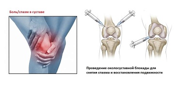 Периартикулярная (околосуставная) блокада