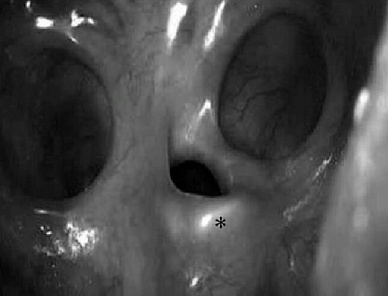 Рассечение синехий носа (1 и 2 стороны)